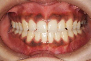 審美歯科の症例